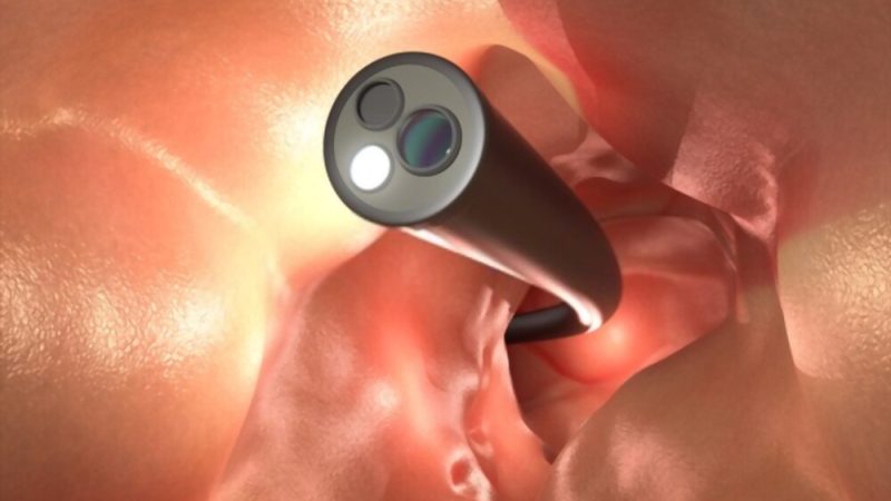 The Colonoscopy: know more about it here